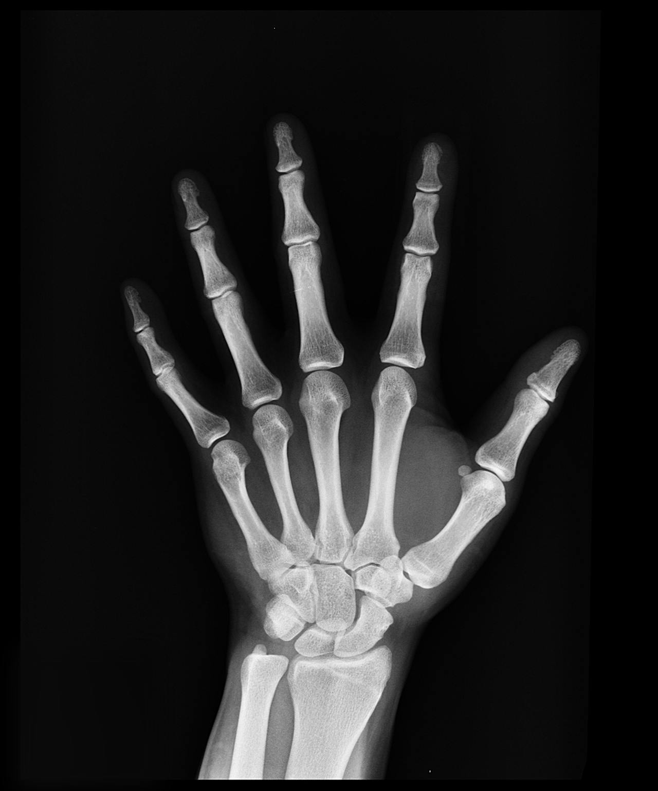 x-ray image of a hand